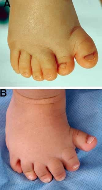 Foot, Preaxial Polydactyly of: