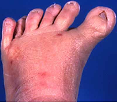 Foot, Postaxial Polydactyly of: Presence of