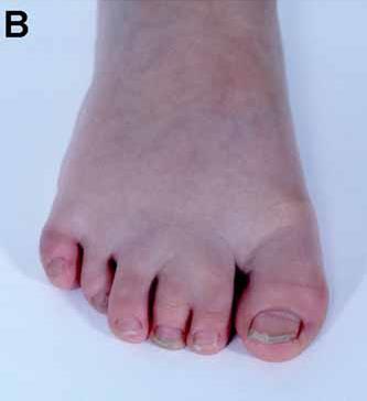 Foot, Polydactyly, Mesoaxial: The presence of a supernumerary toe (not a