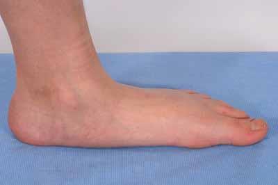 Pes Planus: A foot where the arch is in