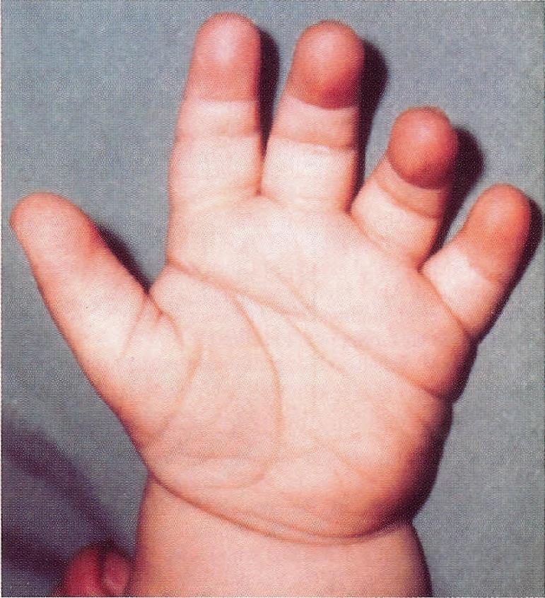 Hands and feet: Brachydactyly Hyopolasia of middle