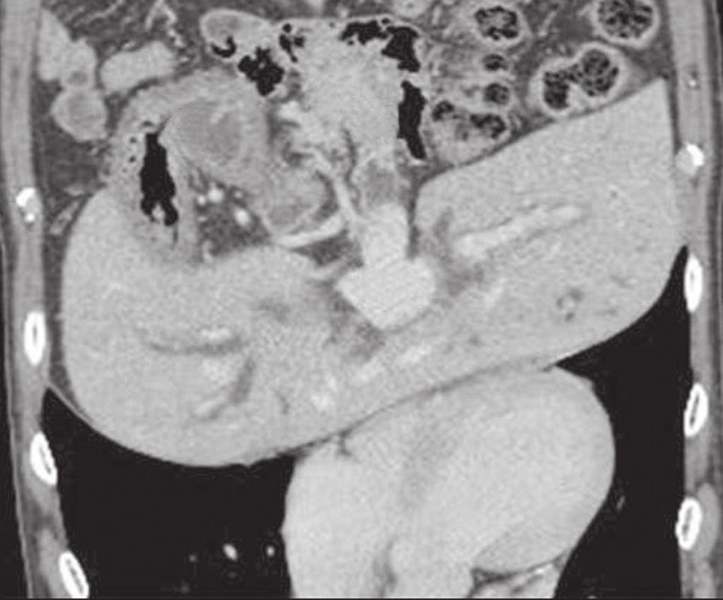 Han-Ki im, et al: Situs ambiguous and malrotation in D CASE REORT A 59-year-old male patient presented with epigastric pain and jaundice.