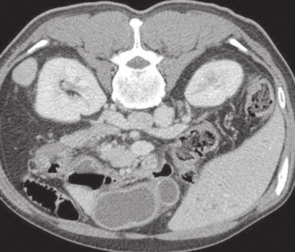 During physical examination, the patient was alert and afebrile, although he was jaundiced, as evidenced by icteric sclera. Abdominal examination revealed epigastric pain without tenderness.