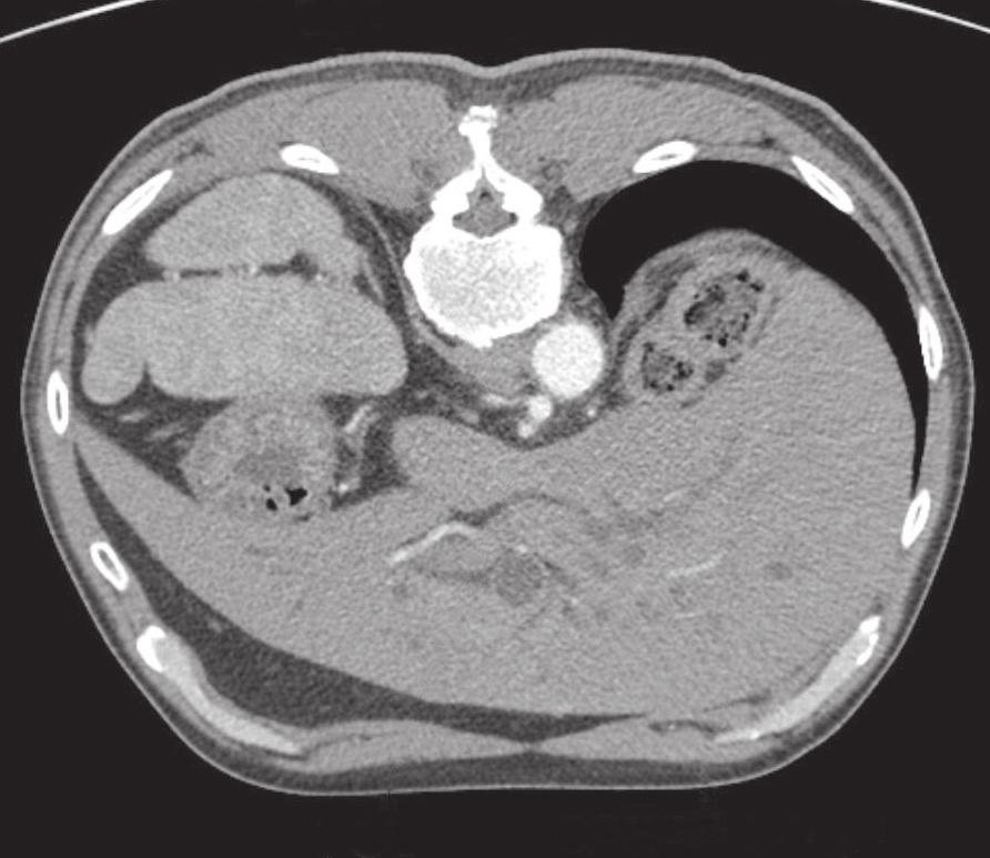 Han-Ki im, et al: Situs ambiguous and malrotation in D GA Celiac trunk CHA SMA RGA Fig. 4. CT scan demonstrating the right gastric artery arising from the celiac trunk.
