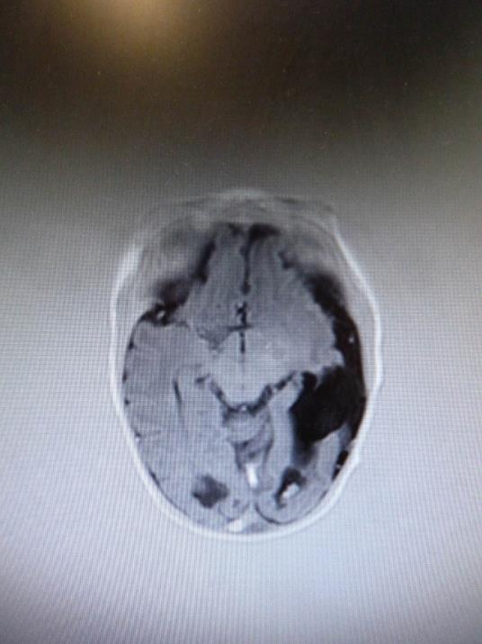 The Importance of Working Together; Brain abnormality noted prenatally Infarct of middle cerebral arteries Baby born with congenital