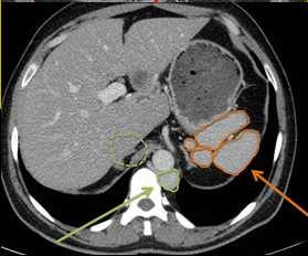 congenitally short pancreas midgut malrotation (80%) gallbladder agenesis (50%) renal