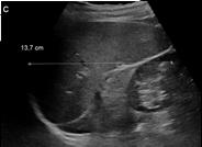 Malformations Splenic pathologies must look for other malformations frequently associated Indirect witness of