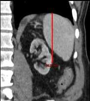 45 cm (width) Splenic index : product of these 3 dimensions Must be lower than 480 cm 3 Longest oblique size of