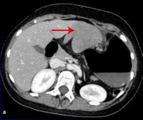 Invisible spleen 1) Agenesia situs ambigus, heterotaxia, isomerism, Ivemark synd 2) Ablation 3) Major atrophy Sickle-cell anaemia, thalassemia, Waquez