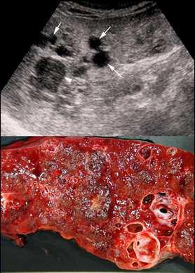 Multiloculated cystic lymphangioma Splenic peliosis Factors involved in peliosis are malignancy, tuberculosis, acquired immune deficiency, diabetes, drugs and parasites Above image from: Youssef