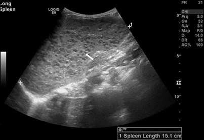 Focal lesions of the spleen Hypoechoic + wall Epidermoïde cyst Hematoma Pseudo Cysts Anechoic without wall Mesothelial simple Cyst Lymphangioma Peliosis Cystic Easy or affordable Solid Mess Solid