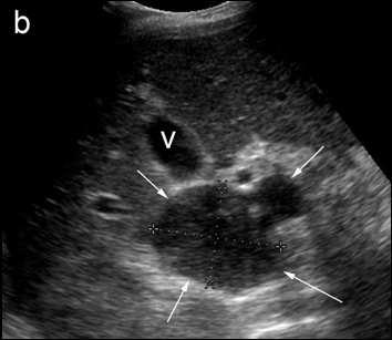 40% Splenomegaly = 50% (diffuse & infiltrative