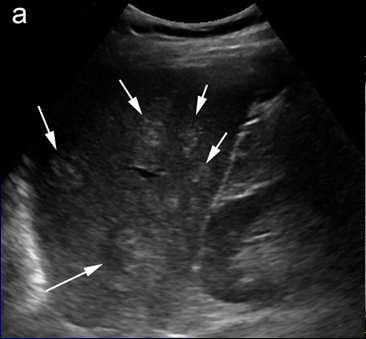 Specific to the spleen multiples nodules hyperechoic in an enlarged