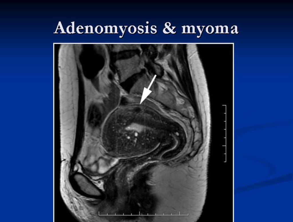 Fig. 3: Myometrial endometriosis (adenomyosis). Sagittal T2 weighted image showing the typical MR signs of adenomyosis in the anterior wall and fundus of the uterus.