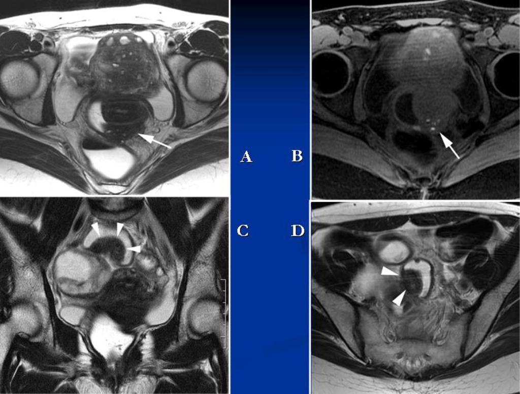 Fig. 7: Deep endometriosis involving rectovaginal septum (arrows). A, B: Axial T2 and T1 FSE images. In this case, small hyperintense foci are detected both on T1 and T2 weighted images.