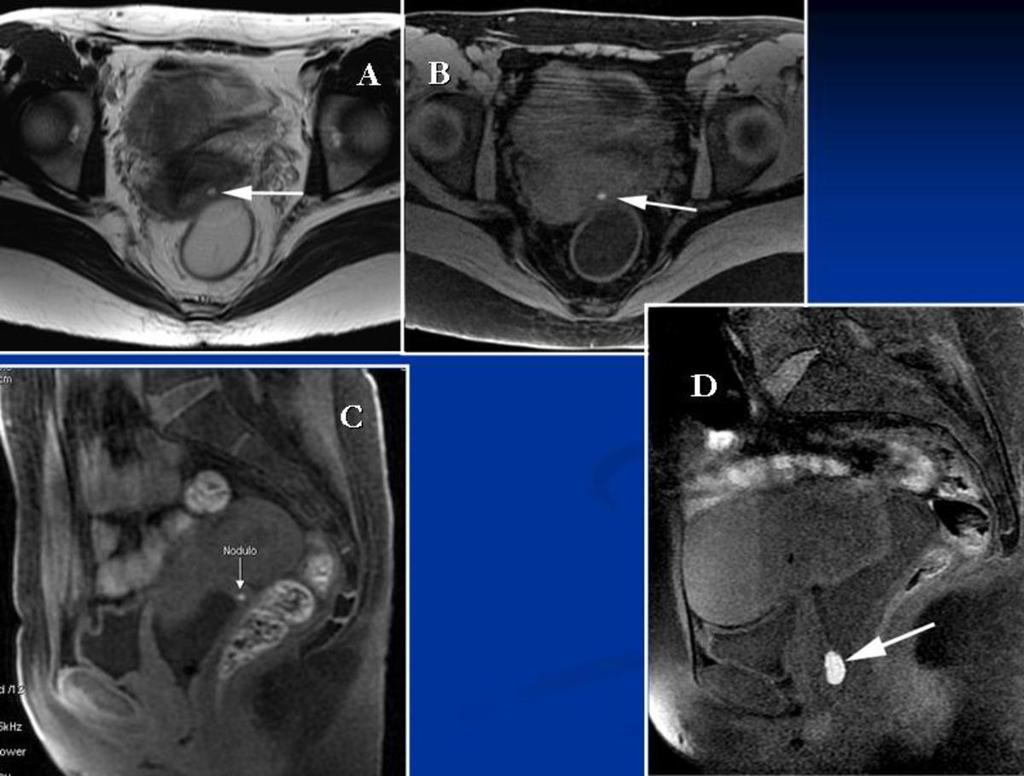 Fig. 8: Vaginal wall endometriosis. A, B: Axial T2 and fatsat T1. Small endometriotic hemorrhagic nodule in the posterior vaginal recess, without other clear implants involving the Douglas pouch.