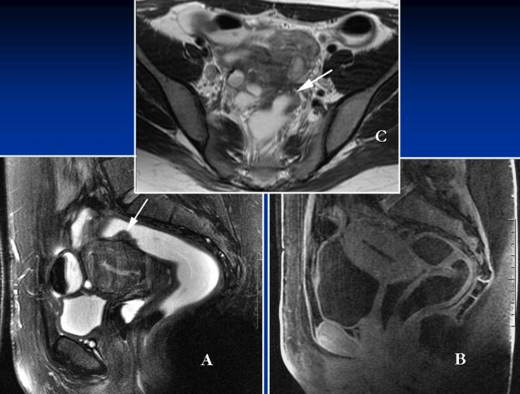 Fig. 9: Adnexal endometriosis and rectosigmoid implant (arrow) with aspect of deep infiltration. Rectovaginal septum is normal.
