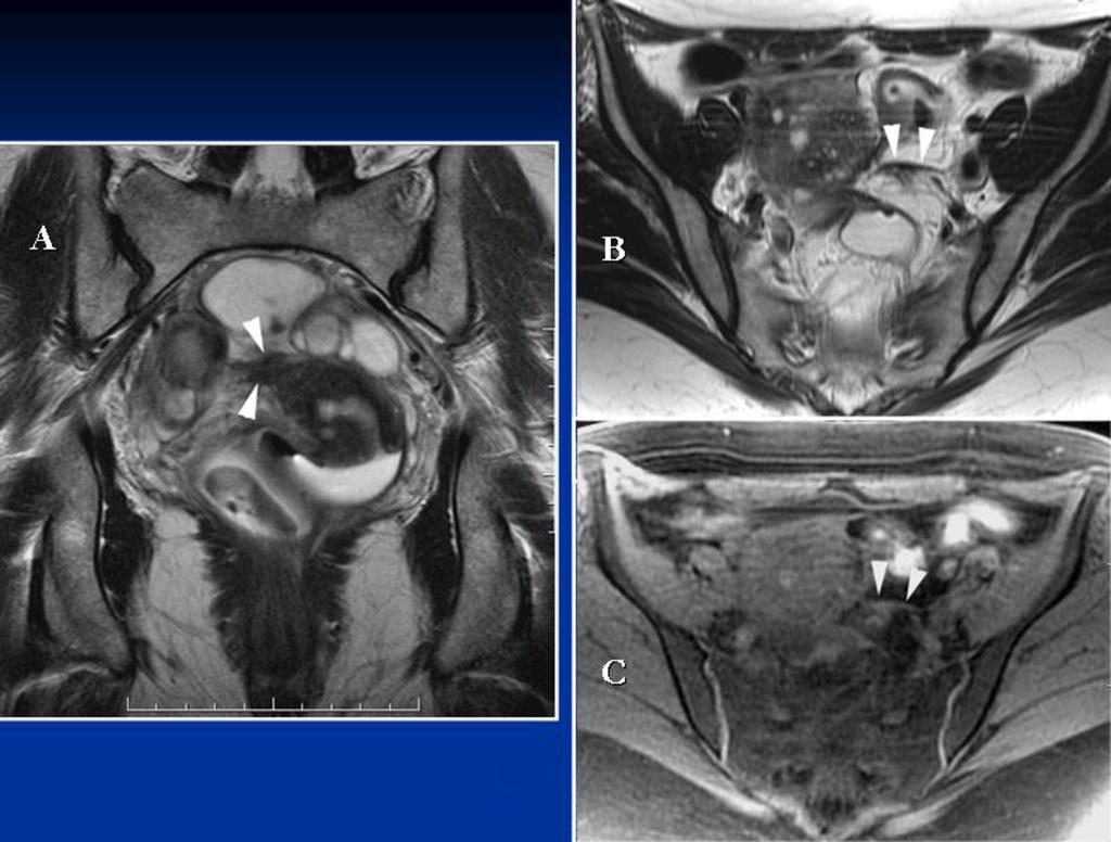 Fig. 12: Uterosacral ligaments. A. There is thickening of the right uterosacral ligament (arrowheads) and the uterine torus, both involved by deep endometriosis, surgically confirmed.