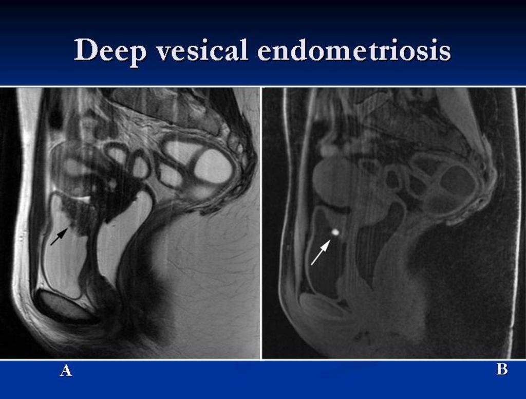 Fig. 13: Deep bladder endometriosis. Sagittal T2-weighted image (A) in which there is a marked thickening of the roof of the bladder, reaching the posterior wall.