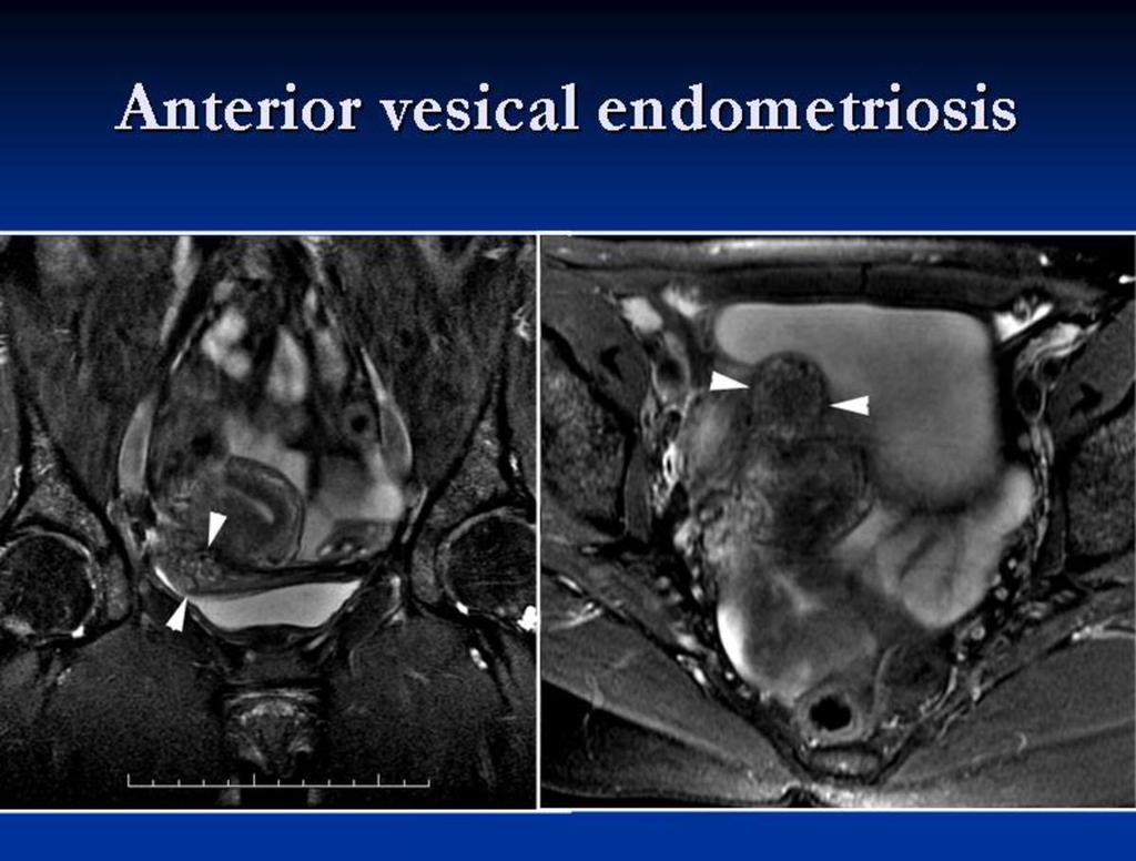 Fig. 14: Bladder endometriotic nodule in another patient, in this case it