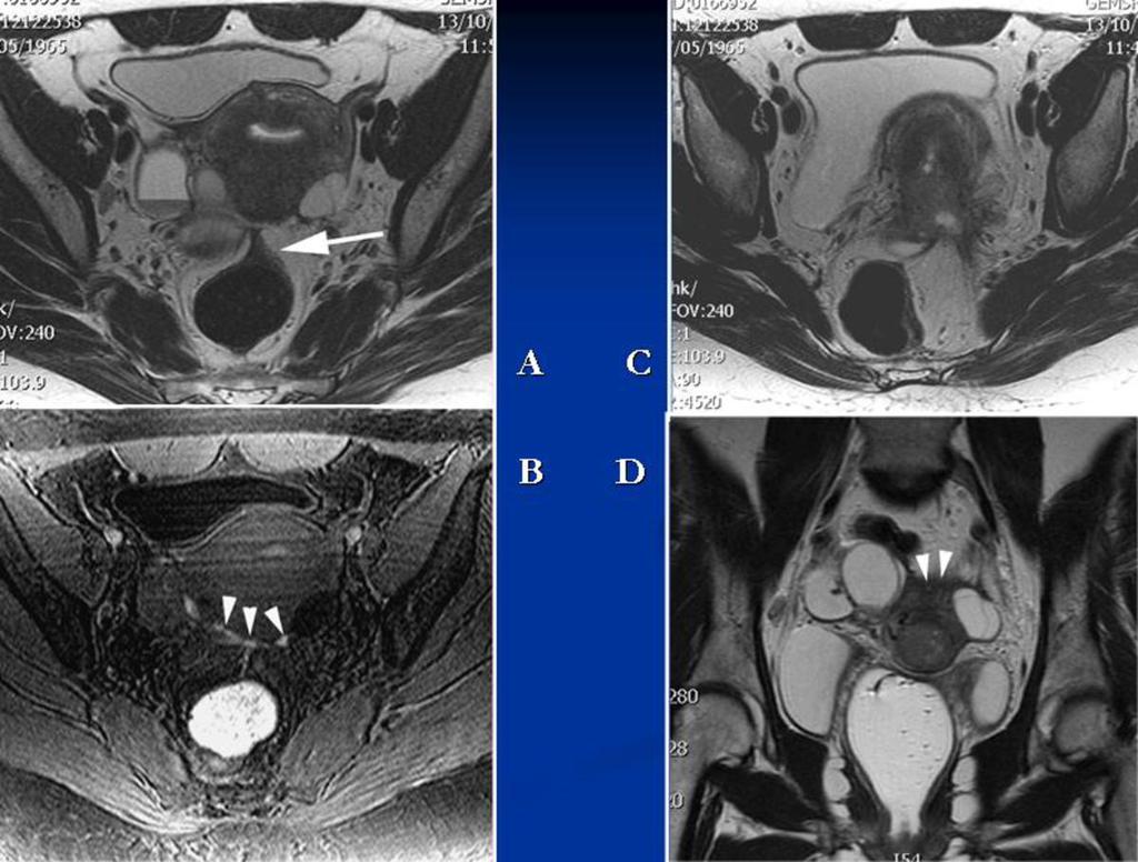 Fig. 17: Endometriosis and tumor. Axial T2 (A) and fatsat T1 (B) images of a patient with bilateral ovarian endometriosis and deep implants in the uterine torus region (arrowheads).