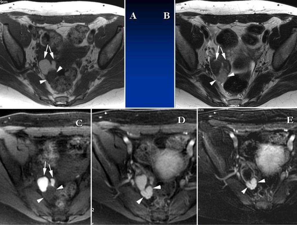 Fig. 18: Endometriosis and tumor: Using IV Gadolinium contrast can be helpful to detect solid ovarian lesions (arrowheads) associated to endometriotic hemorrhagic cysts, as in this