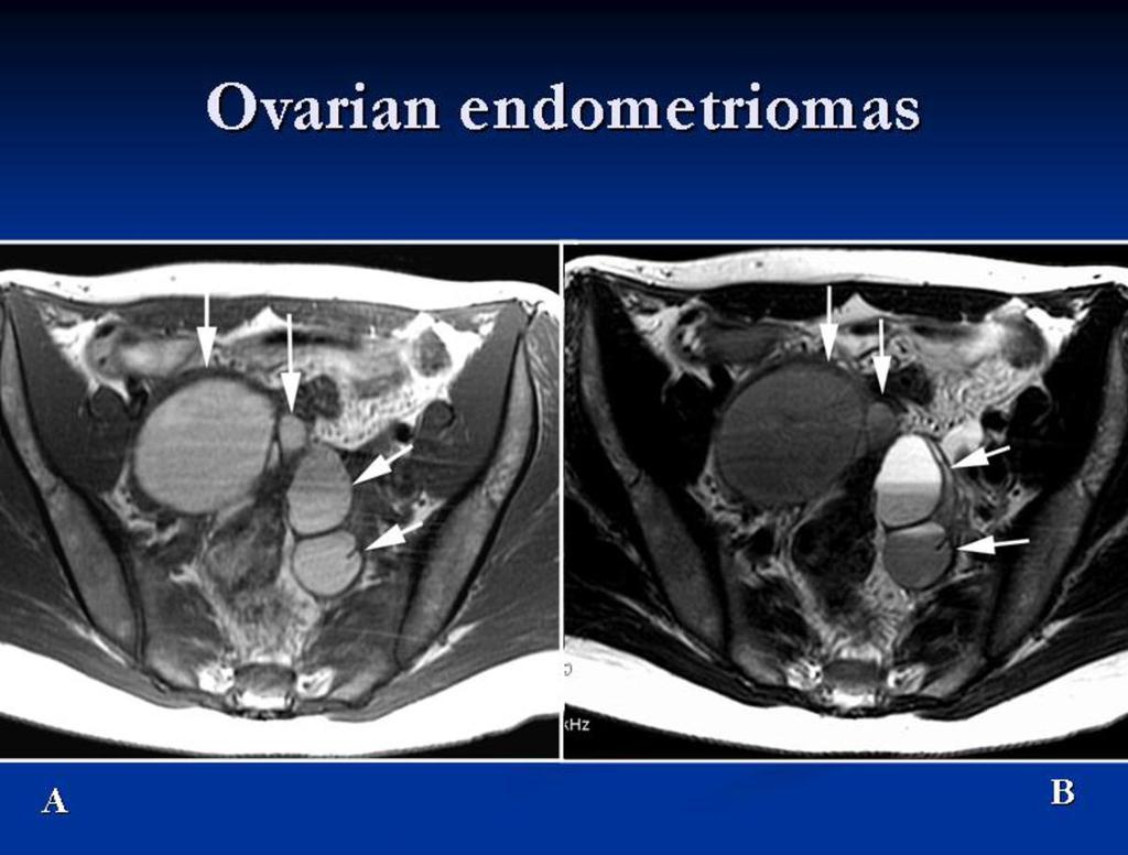 Fig. 1: Typical MR characteristics of ovarian endometriomas.