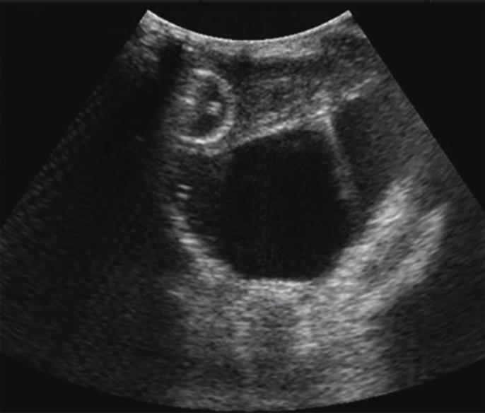 (b) Insertion of a Foley catheter makes it clear that the cystic mass is separate from the urinary bladder which is severely compressed and therefore hard to detect on ultrasound. abdominal mass.