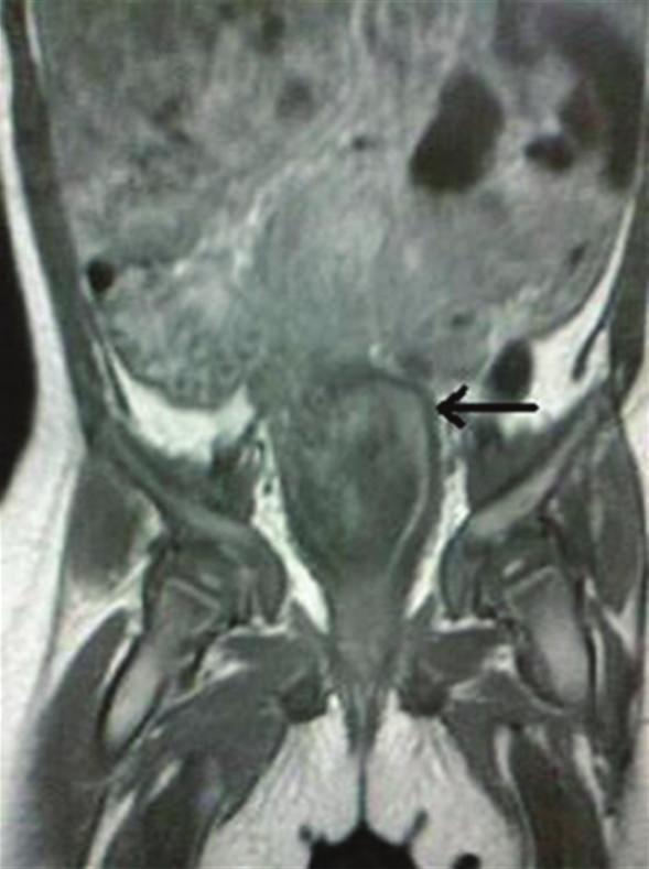 (c) axial view through corpus shows bicornuate uterus. perforate during the later stages of embryonic development [8].