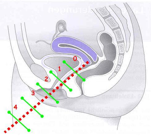 In fact for clinical examination, POP-Q classification is as follows: Grade 0: No genital prolapse Grade I: The end of the genital prolapse is located 1cm upper to the hymen.