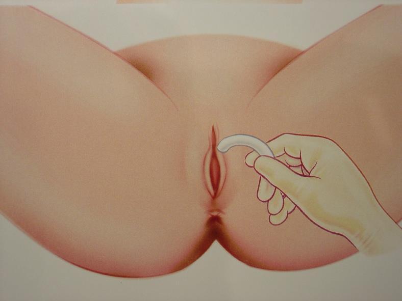INSERTION TECHNIQUE Slide it into the vagina, and curve posteriorly Release and allow to spring open to its normal shape