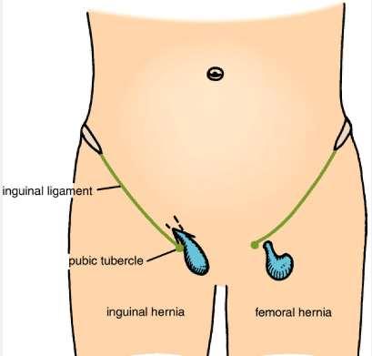 As the hernial sac enlarges, it emerges through the saphenous opening then turns upwards along the pathway presented by the superficial epigastric and superficial circumflex iliac vessels so that it