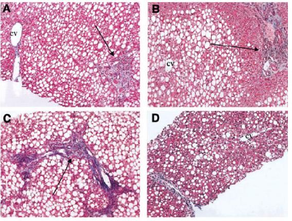 A,B: absent ballooning degeneration & peri-sinusoidal fibrosis with steatosis & portal inflammation C: portal fibrotic expansion & steatosis D: peri-portal