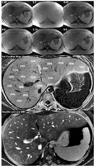 15 yo with cirrhosis due to NASH Fat fraction map double-contrast enhanced MR showing fibrotic