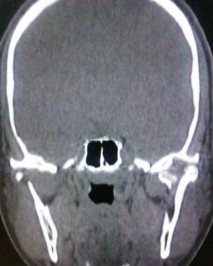 Fig. 5. Coronal CT of case 2 showing sagittal fracture of Lt condyle. Fig.6. 3D CT of case 2 showing sagittal fracture of Lt condyle. References: 1) Hakubun Yonezu, Takashi Yakushiji, Ken ichiro Suga.