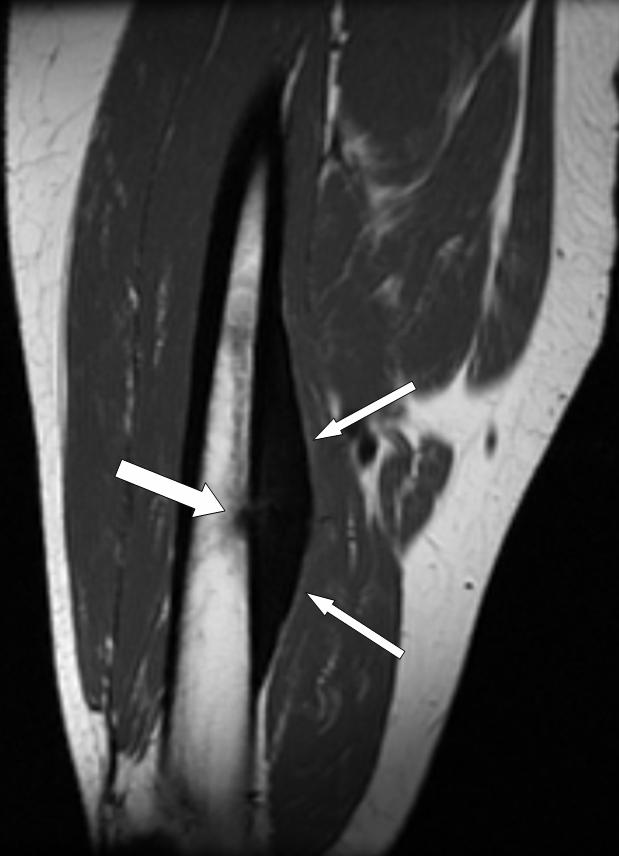 Summary of Imaging Findings Anteroposterior (AP) and lateral (lateral not shown) radiographs of the right femur demonstrated a zone of thick cortical thickening with a smooth contour along the medial