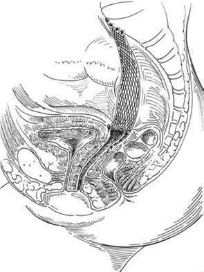 The Obstetrician & Gynaecologist Figure 2 Abdominal sacrocolpopexy showing mesh attachment from the sacrum to the vaginal vault Figure 3 Position of mesh in laparoscopic sacrocolpopexy.