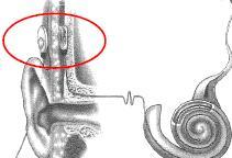 20 Cochlear Implants (CI) The most common cause of sensorineural hearing loss is the loss of hair cells rather than the loss of auditory
