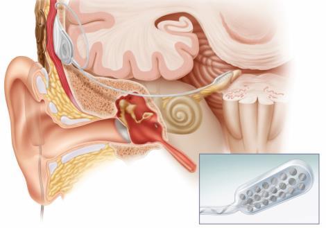 loss Medication, Surgery, Hearing aids, Middle ear implant or BAHA Neural hearing loss Absence or