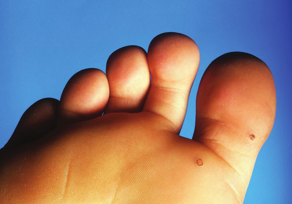 2.0 ANCC CONTACT HOURS Waging a war on warts Usually considered a benign skin disease, warts can be painful and unsightly, affecting your patients comfort and body image. By Richard L. Pullen, Jr.