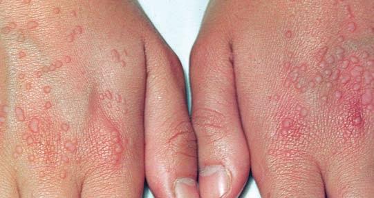Individuals with plantar warts sometimes feel as if they have rocks in their socks.