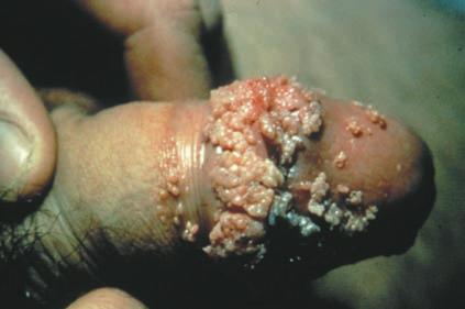 Caused by HPV types 6, 11, 16, and 18, anogenital warts are sometimes referred to as condyloma acuminata.