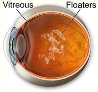 (asymptomatic) Cataract Fine stellate KPs