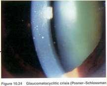 Posner-Schlossman Posner-Schlossman = Recurrent Glaucomatocyclitic Crisis Acute attack of unilateral IOP rise (>40mmHg),