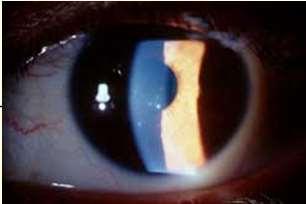 Clinical features Unilateral Mild pain Colored halos/blurred vision