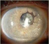 Phacolytic glaucoma