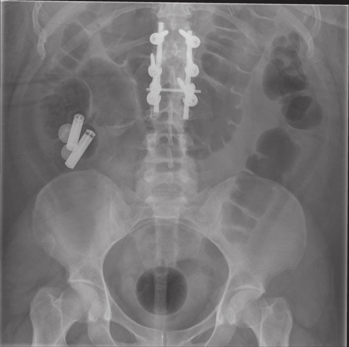 2 Case Reports in Gastrointestinal Medicine Figure 1: X-ray presenting a cluster of four batteries, two button batteries, and two cylindrical ones in