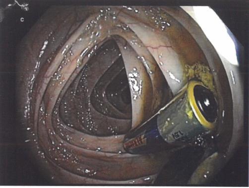 Under the implementation of endoscopic loops and Dormia basket, three of overall four batteries were removed from cecum as they have already passed