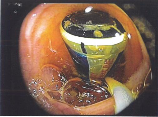Case Reports in Gastrointestinal Medicine 3 (a) (b) (c) (d) Figure 3: The cylindrical battery was detected in terminal ileum, grasped with an endoscopic loop and pulled through the valve ((a) and