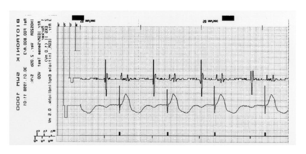 April 1999 123 Figure 5a. ECG recording demonstrating asynchronous ventricular pacing in a patient with an Inos device; visible P waves rule out atrial flutter or fibrillation. Figure 5b.